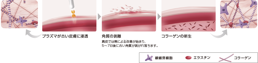 プラズマ治療