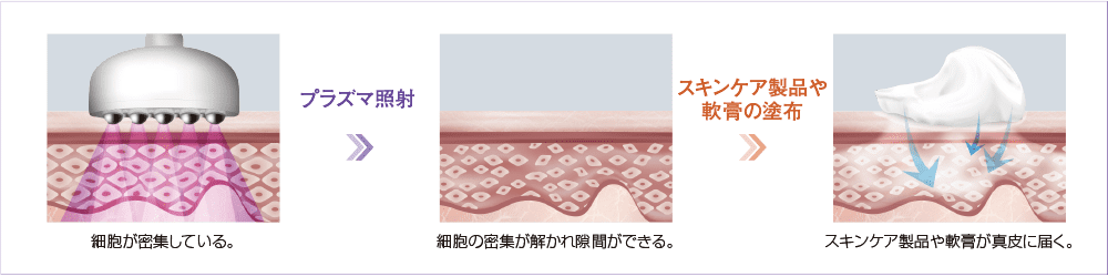 ニキビ治療