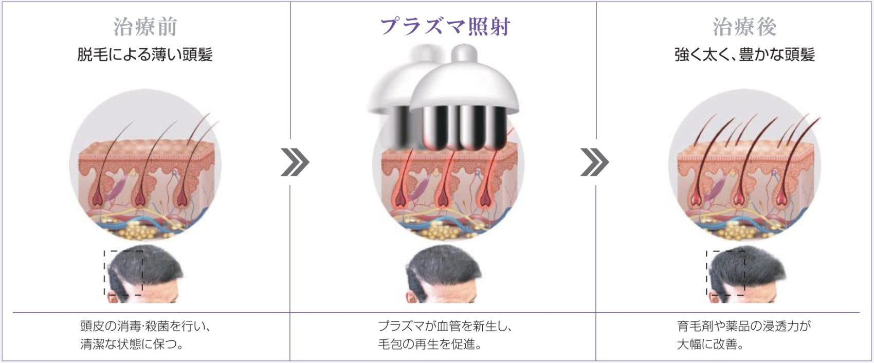 頭皮ケア
